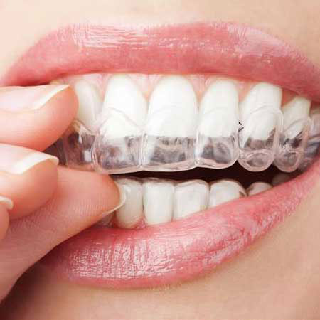 بلیچینگ دندان خانگی